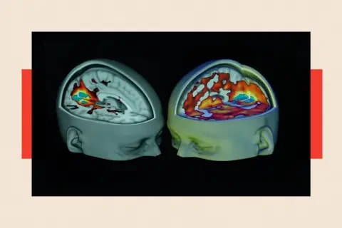 A picture of a brain scan of a person who has not taken psychedelics next to the hyperactive brain of someone who has taken psychedelics