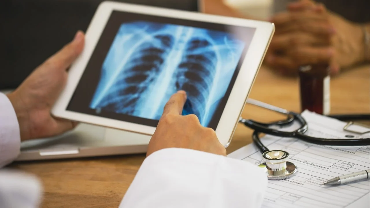 Targeted Therapy May Transform Advanced Lung Cancer into a Manageable Condition, CUHK Research Reveals